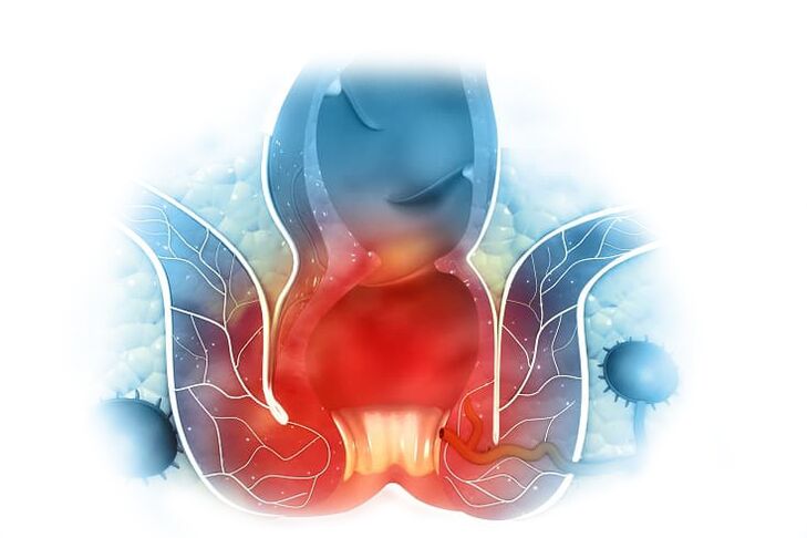 Traitement efficace des hémorroïdes internes et externes avec la crème Proctonic